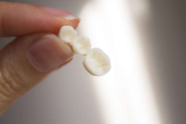 Bridges Vs  Dental Implants: Which Is Better