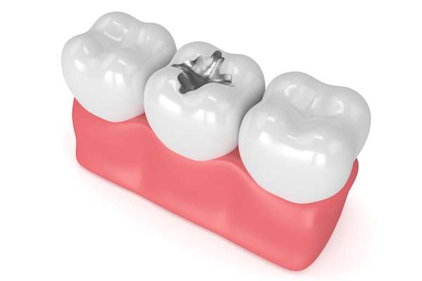 A Family Dentist Explains Fillings from Great Smile Dental in Marietta, GA